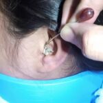 耳掃除の難聴 最大の耳垢除去 | #T7H98