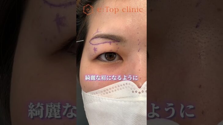 眉下リフトでナチュラルに変化👀#眉下リフト #眉下切開