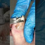 🧼 restoring a nail’s life step by step 👣 #nailtreatment #infectioncare #trending #viral