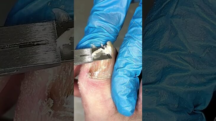 🧼 restoring a nail’s life step by step 👣 #nailtreatment #infectioncare #trending #viral