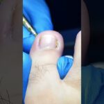 🦶 Ingrown nail causing infection removed 💉🔥🩹#trending #viral #footcare #healthtips