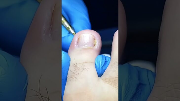 🦶 Ingrown nail causing infection removed 💉🔥🩹#trending #viral #footcare #healthtips