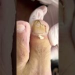 🦶 Reviving a broken overgrown toenail 💅✨💖#trending #viral #footcare #nailcare