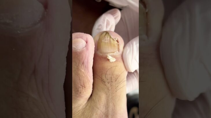 🦶 Reviving a broken overgrown toenail 💅✨💖#trending #viral #footcare #nailcare