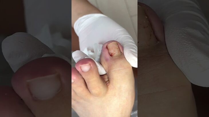 🦶 Ingrown big toe nail removed safely 💉🔥🩹#trending #viral #footcare #healthtips