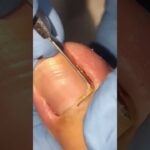 💉 Ingrown nail extraction for healing 🦶💊🔥#trending #viral #healthtips #footcare