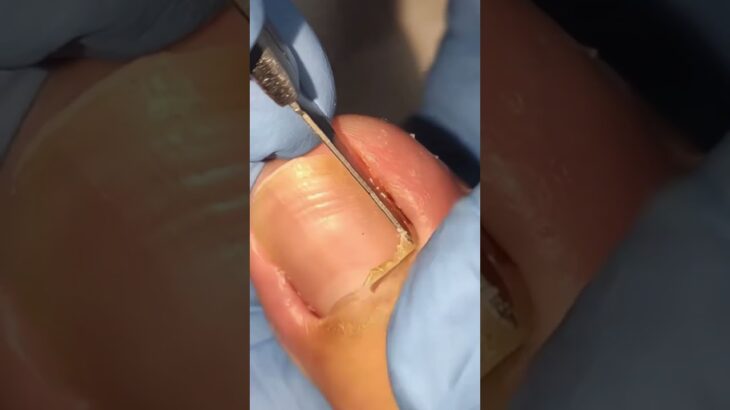 💉 Ingrown nail extraction for healing 🦶💊🔥#trending #viral #healthtips #footcare