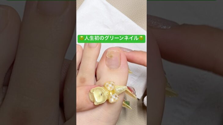 オフしたらまさかのグリーンネイルに!?😱 #グリーンネイル #ネイルトラブル #ネイルオフ #フットネイル #セルフネイル #ジェルネイル